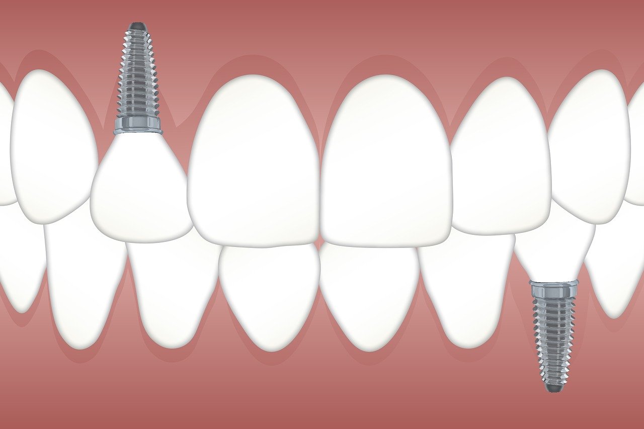 Implanty zębów – czy warto w nie zainwestować?